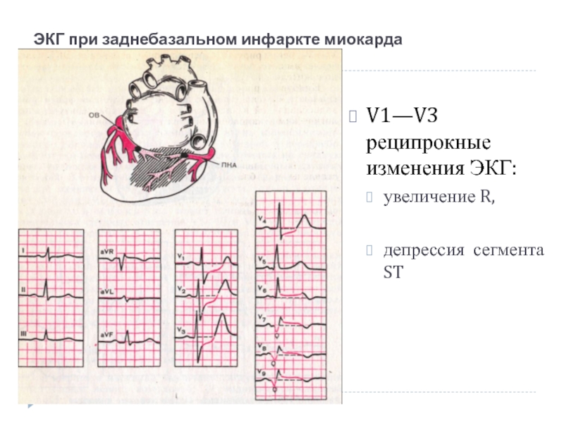 ЭКГ при заднебазальном инфаркте миокарда V1—V3 реципрокные изменения ЭКГ:увеличение R,депрессия сегмента ST