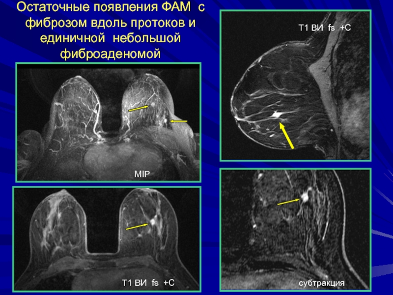 Локализованный фам молочной железы что это такое. Субтракция мрт. Фиброаденома молочной железы кт. Мрт протоков молочной железы.