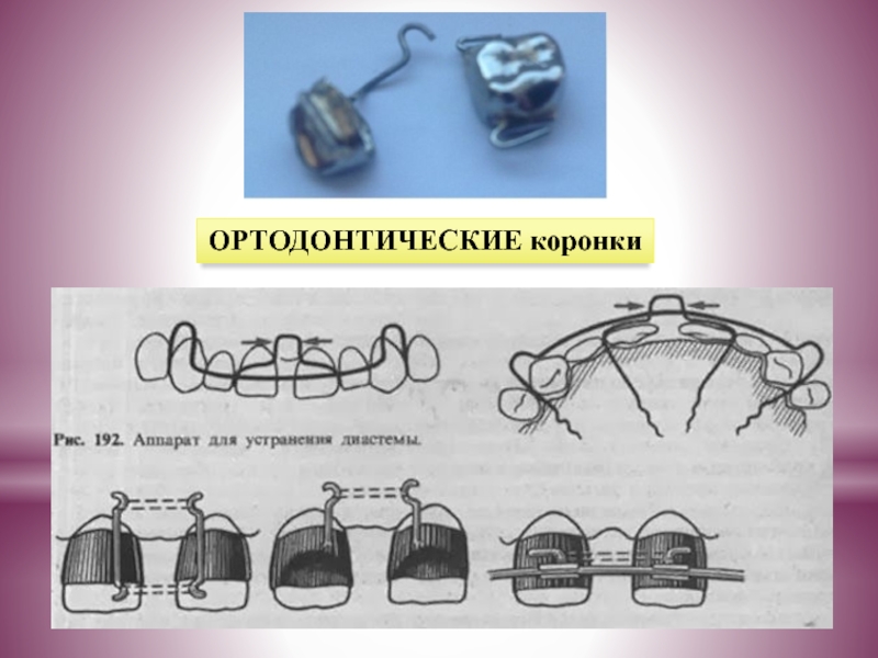 Ортодонтическое кольцо для детей