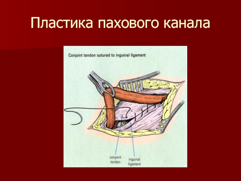 Схема пластики пахового канала