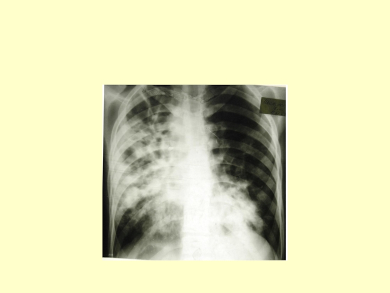 Врожденный туберкулез. Классификация туберкулеза легких рентген. Туберкулез легкого рентген классификация. Классификация туберкулёза лёгких рентген.