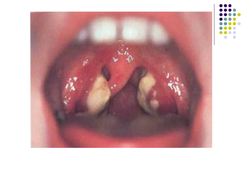 Mononucleosis cuando puedo volver a besar