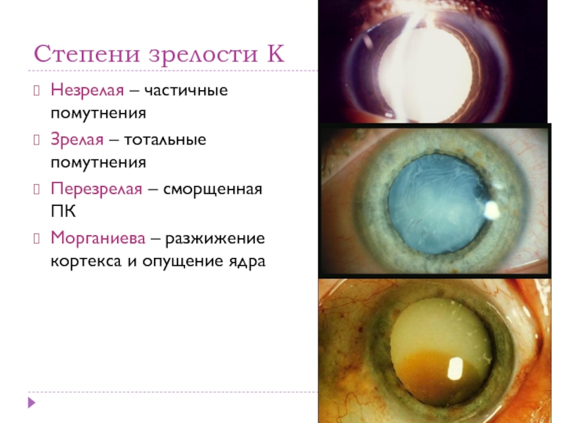 Презентация по офтальмологии катаракта