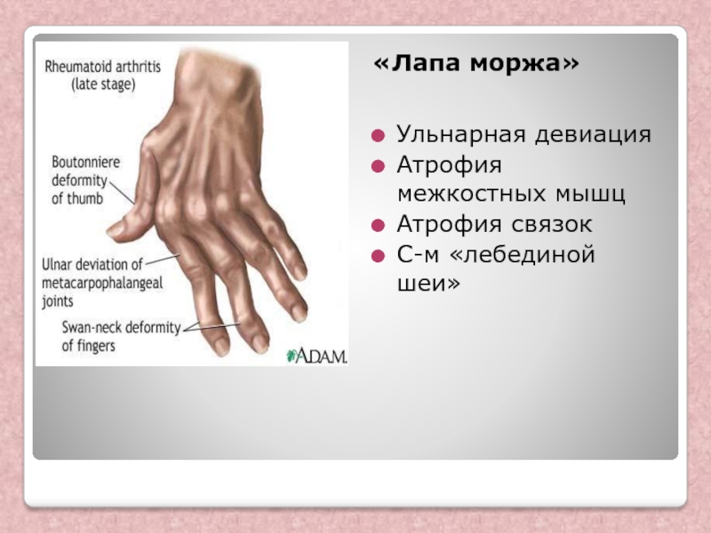 Ревматоидный артрит мышцы. Ревматоидный артрит деформация кисти. Ульнарная девиация пальцев кисти. Ульнарная девиация в пястно-фаланговых суставах. Ревматоидный артрит деформация суставов.
