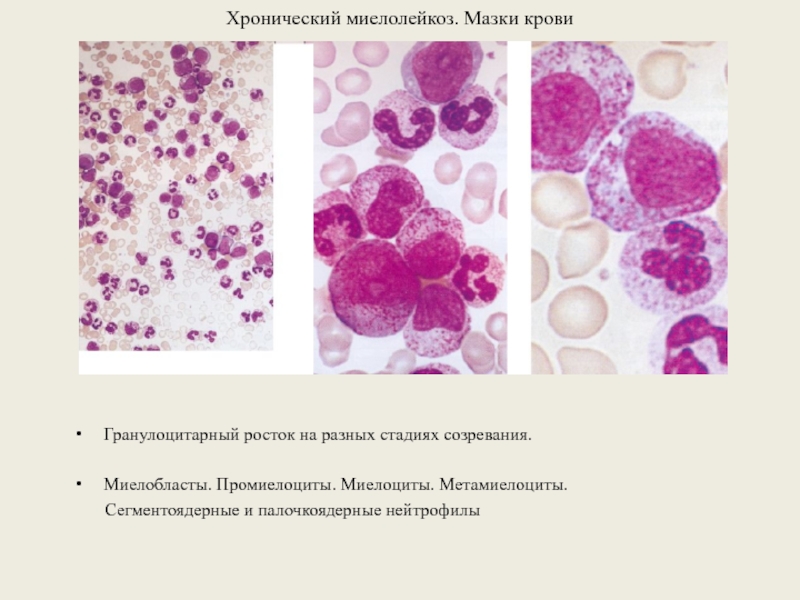 Хронический миелолейкоз презентация