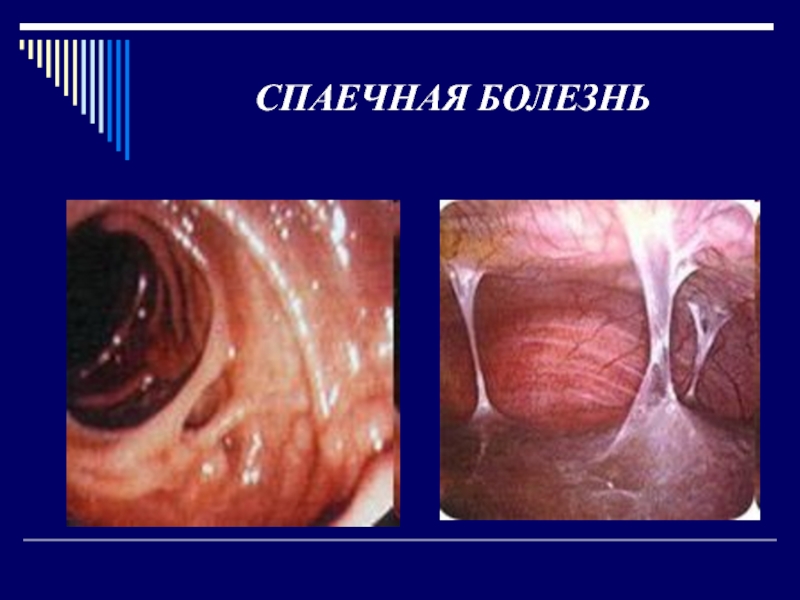 Реферат: Спаечная болезнь