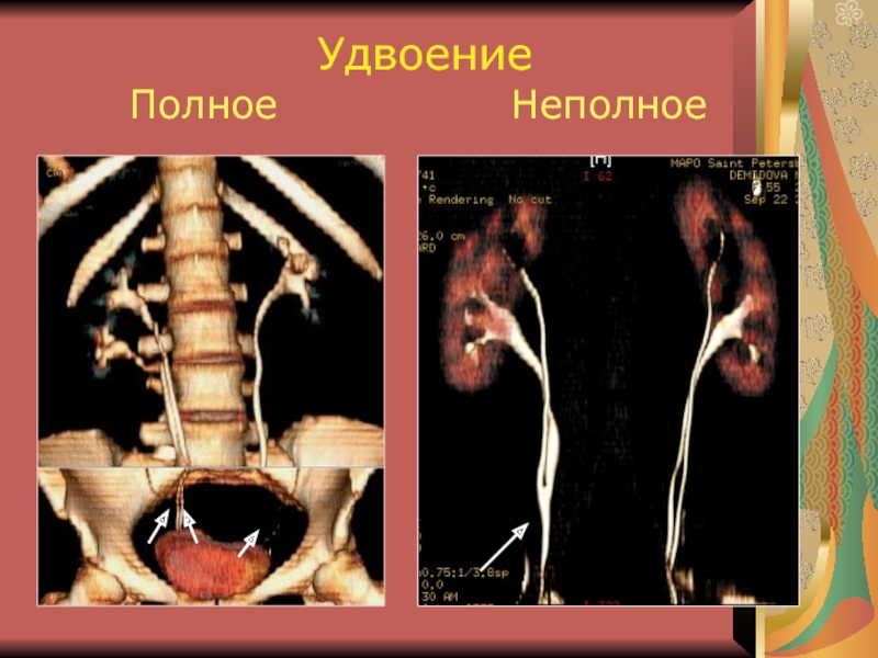 Аномалия развития почек презентация