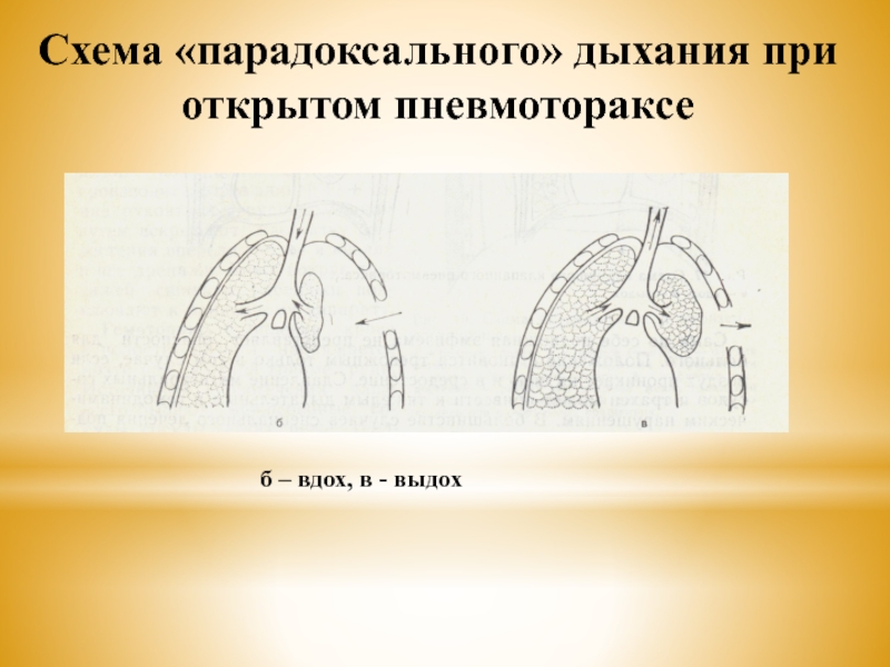 Открытый пневмоторакс. Схема парадоксального дыхания. Дыхание при открытом пневмотораксе. Парадоксальное дыхание при пневмотораксе. Открытый пневмоторакс схема.