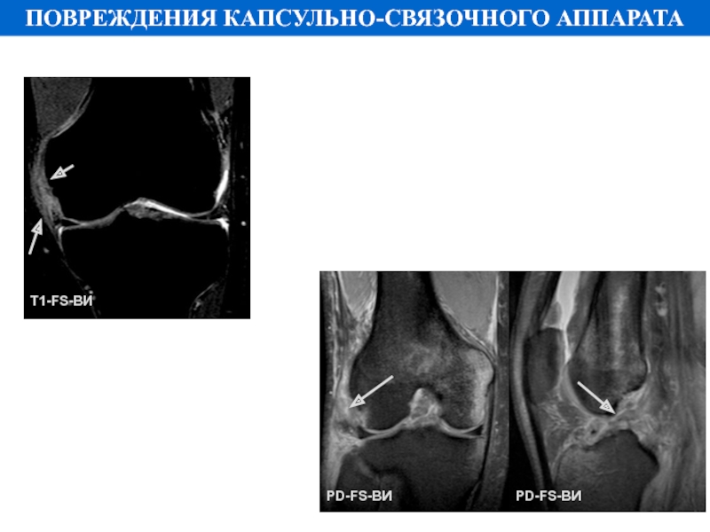 Повреждение капсульно связочного аппарата