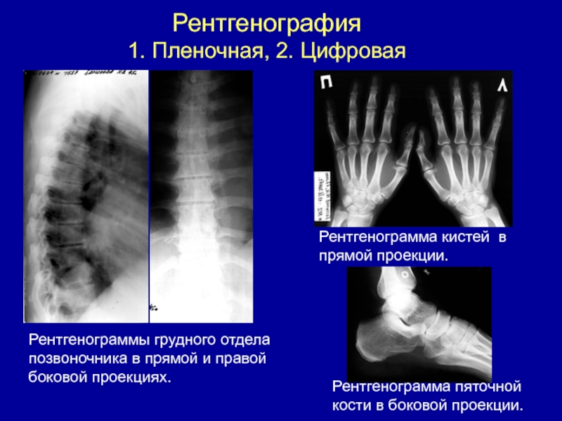 Почему на рентгеновском снимке изображение костей получается белым