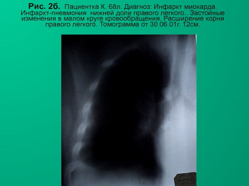 Н.С. Воротынцева, С.С. Гольев РентгенопульмонологияРис. 2б. Пациентка К. 68л. Диагноз: Инфаркт миокарда. Инфаркт-пневмония нижней доли правого легкого..