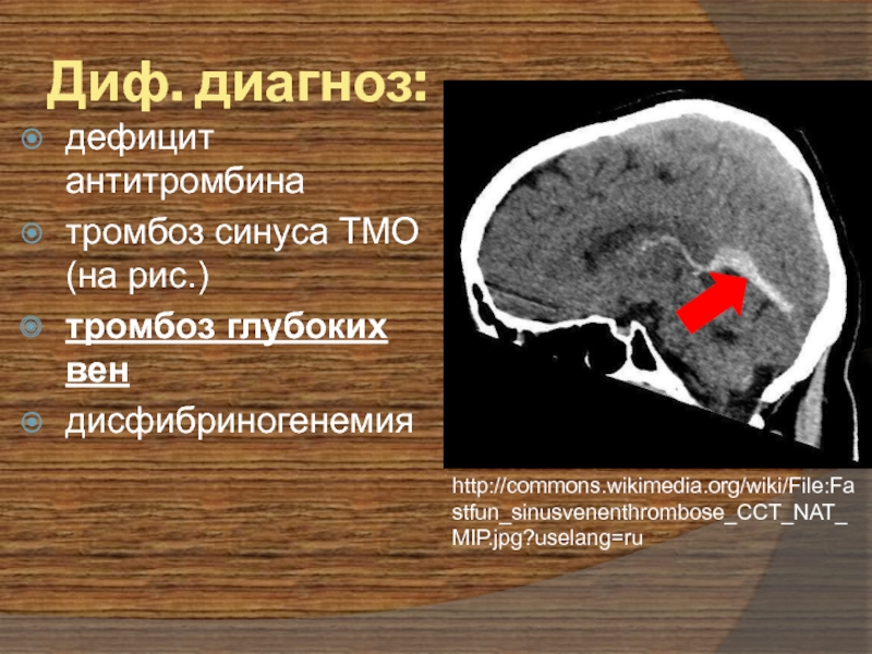 Тромбоз кавернозного. Тромбоз пещеристого синуса дифференциальная диагностика. Тромбоз синусов твердой мозговой оболочки. Диф диагностика тромбоз кавернозного синуса. Дифференциальный диагноз тромбоз.