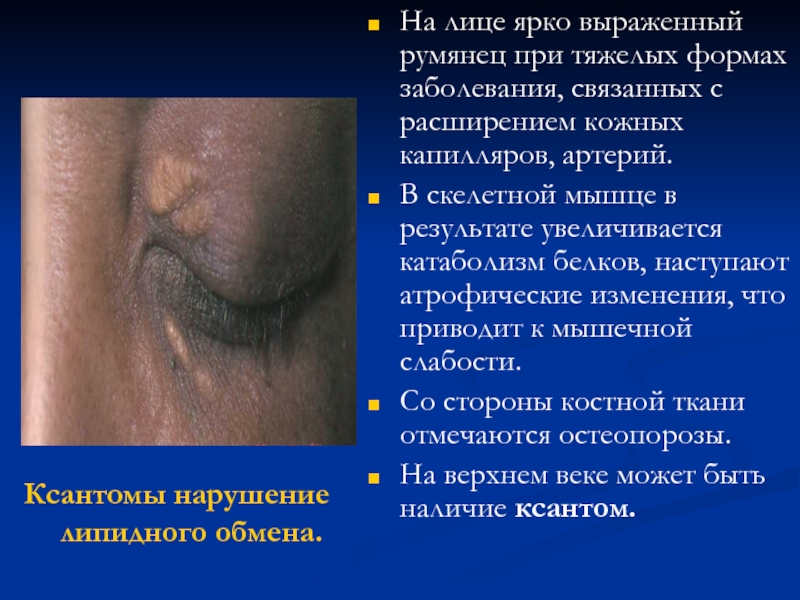На лице ярко выраженный румянец при тяжелых формах заболевания, связанных с расширением кожных капилляров, артерий.В скелетной мышце
