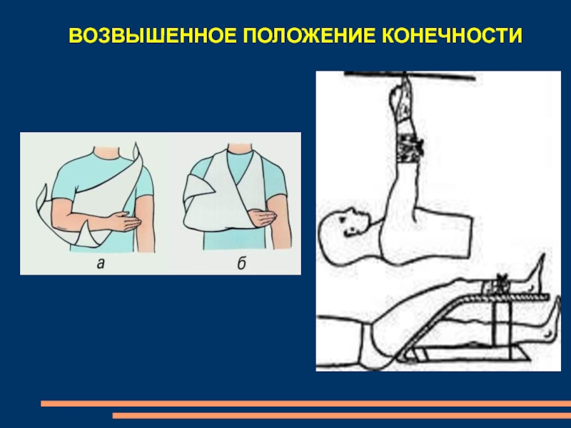 Положение конечностей. Возвышенное положение конечности. Возвышенное положение конечности при кровотечении. Возвышенное положение ног. Обеспечить возвышенное положение конечности.