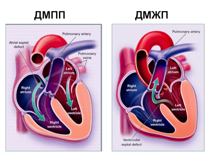 Гемодинамика дмжп у детей схема