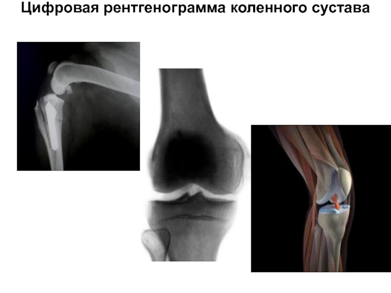 Цифровая рентгенограмма коленного сустава