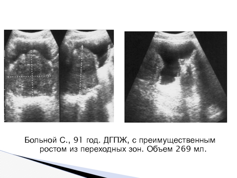Дгпж узи. Гиперплазия предстательной железы УЗИ. Зоны гиперплазии предстательной железы на УЗИ. Переходная зона предстательной железы на УЗИ.