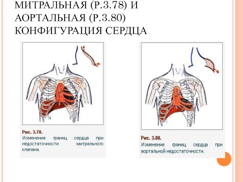 Аортальная конфигурация сердца схема