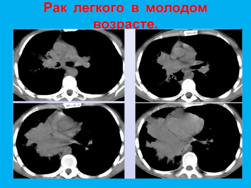 Возраст легких. Онкология лёгких в каком возрасте. Карцинома легких в каком возрасте. Возраст лёгких 25 гг.