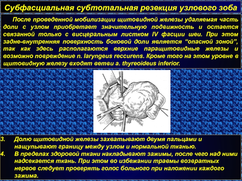 Операция узел. Субфасциальная резекция щитовидной железы. Субтотальная резекция щитовидной железы. Субтотальная субфасциальная резекция щитовидной. Осложнения субтотальной резекции щитовидной железы.