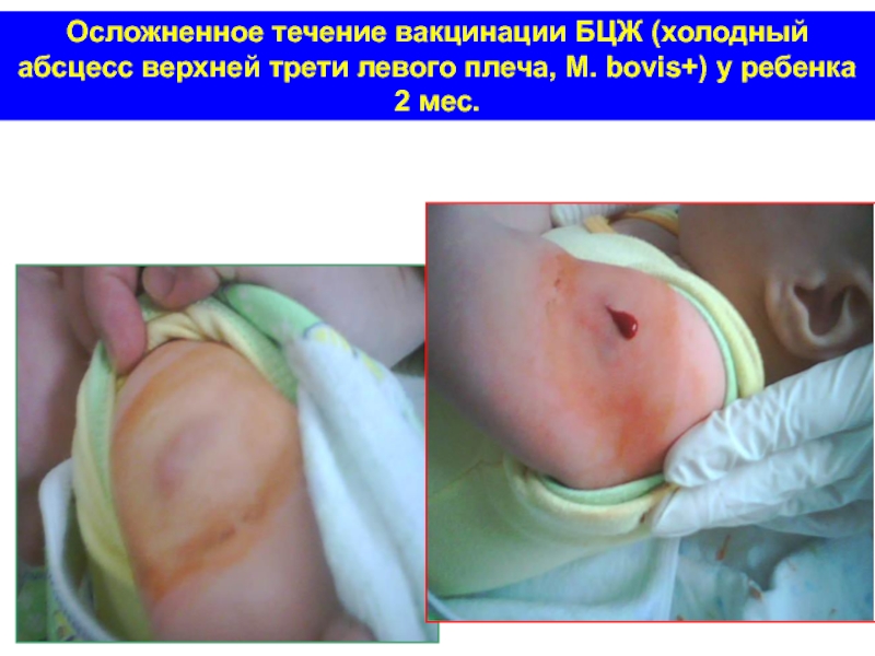 Осложненное течение вакцинации БЦЖ (холодный абсцесс верхней трети левого плеча, М. bovis+) у ребенка 2 мес.