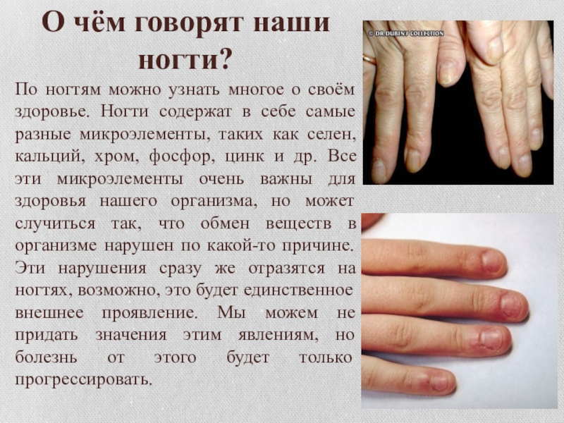 О чем говорит заболевание ногтей. Ногти при различных заболеваниях. Болезни по ногтям на руках таблица. Определить болезнь по ногтям.