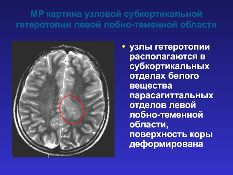 Единичный очаг в левой лобной доле. Субкортикальная гетеротопия. Гетеротопия серого вещества. Субкортикальные очаги головного мозга. Очаги в белом веществе лобных долей.