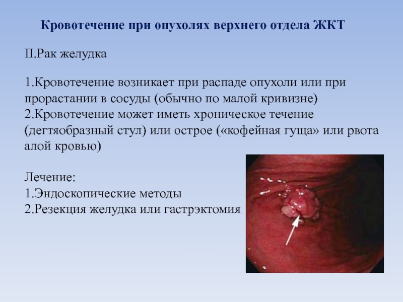 Кровотечение при опухолях верхнего отдела ЖКТII.Рак желудка1.Кровотечение возникает при распаде опухоли или при прорастании в сосуды (обычно