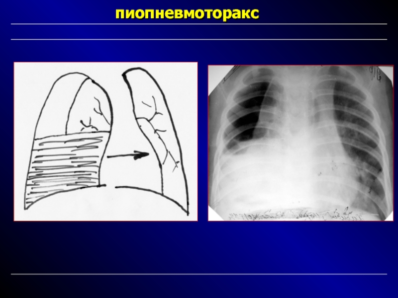 На рентгенологической картине напряженного пиопневмоторакса отмечается смещение средостения в