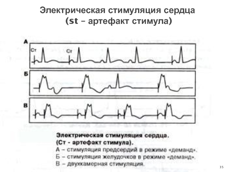 Электрическая стимуляция сердца  (st – артефакт стимула)