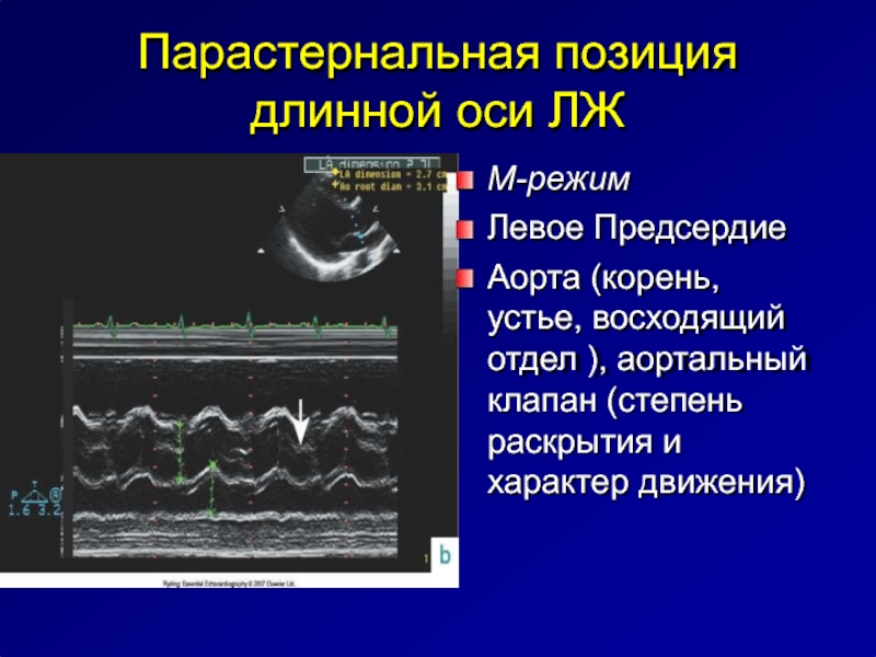 М режим. Парастернальная позиция в ЭХОКГ. М-режим эхокардиографии. Эхокардиография левый парастернальный по длинной оси. Парастернальная позиция длинная ось.