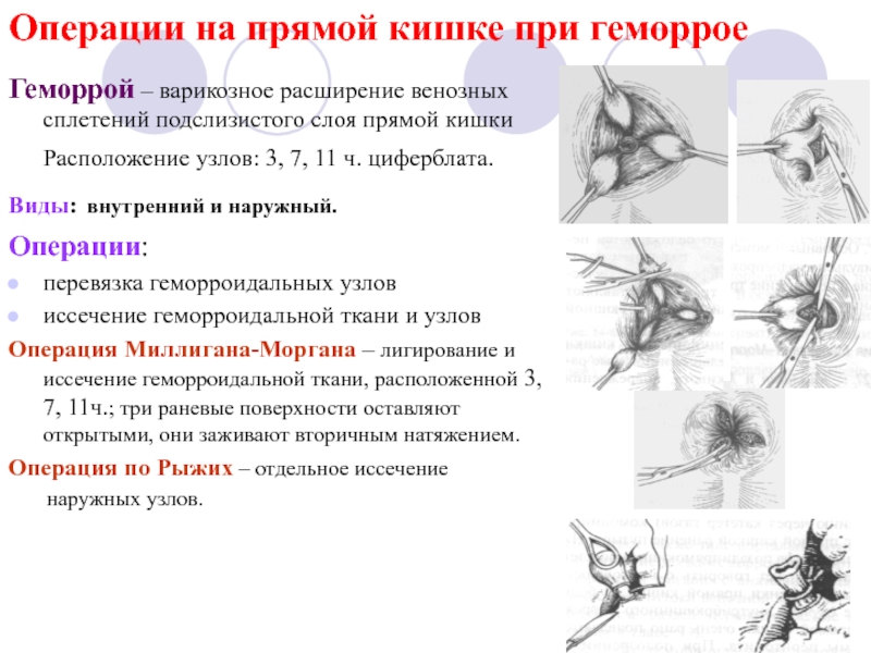 Геморрой карта вызова