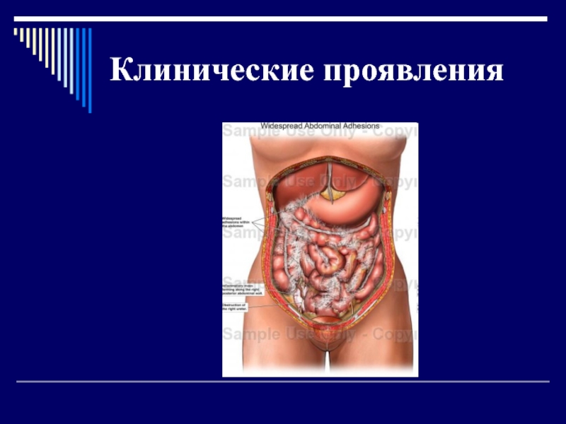 Реферат: Спаечная болезнь