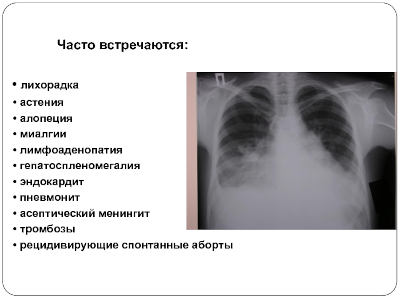 Пневмонит это. Волчаночный пневмонит. Пневмония и пневмонит отличие. Химический пневмонит.