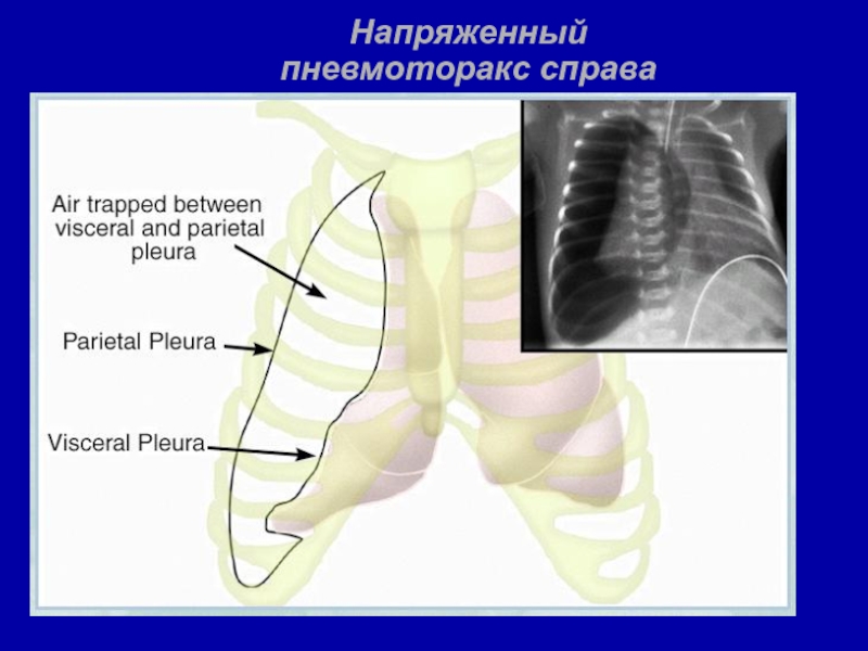 Напряженный пневмоторакс. Напряженный и ненапряженный пневмоторакс. Напряжённый пневмоторакс справа рентген. Напряженный пневмоторакс клиника.