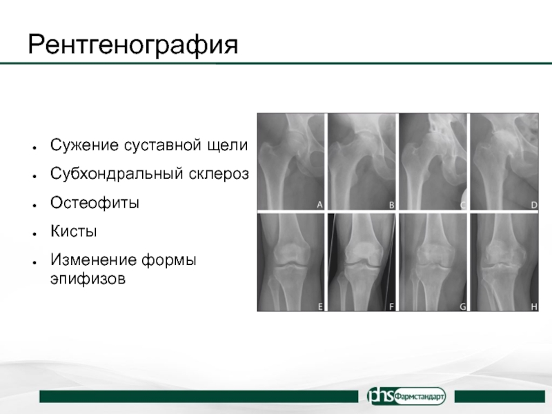 Склероз и краевые остеофиты. Сужение суставной щели. Субхондральный склероз. Субхондральный остеосклероз рентген. Ширина суставной щели в норме.