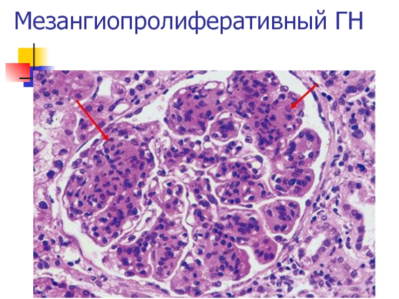 Морфологическая картина гломерулонефрита