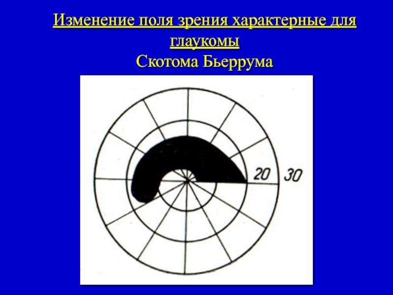 Как изменяется поле зрения. Скотома Бьеррума. Скотома Бьеррума при глаукоме. Периметрия скотомы. Скотома в зоне Бьеррума.