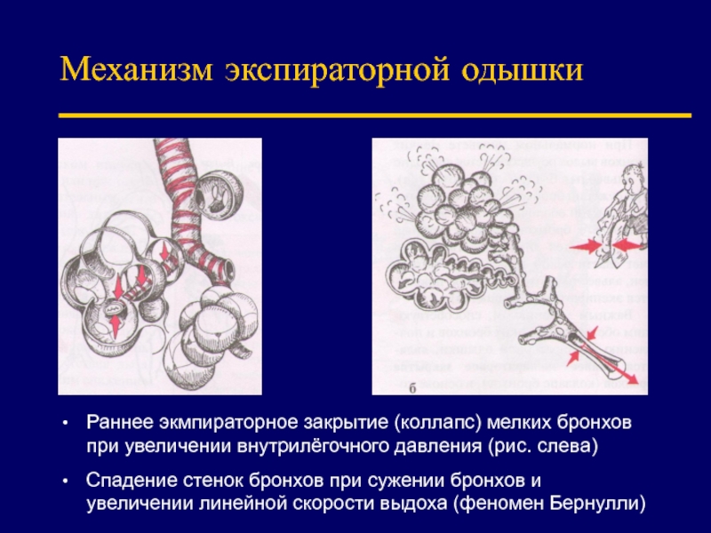 Экспираторная одышка