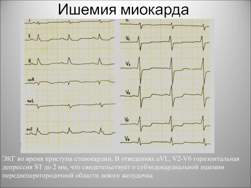 Подъем st в avl. AVF v2 v3 в ЭКГ это. Депрессия St на ЭКГ v3,v4,v6. Субэндокардиальный инфаркт миокарда.