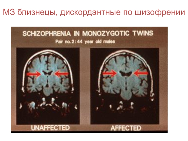 Шизофрения мозг фото