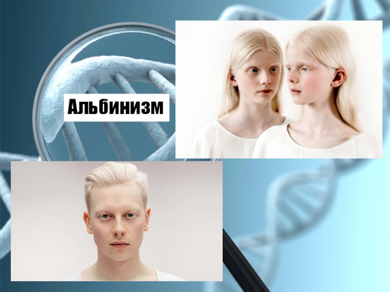 Альбинизмом страдают. Альбинизм это геномная мутация. Альбинизм генная мутация. Наследственная болезнь альбинизм.
