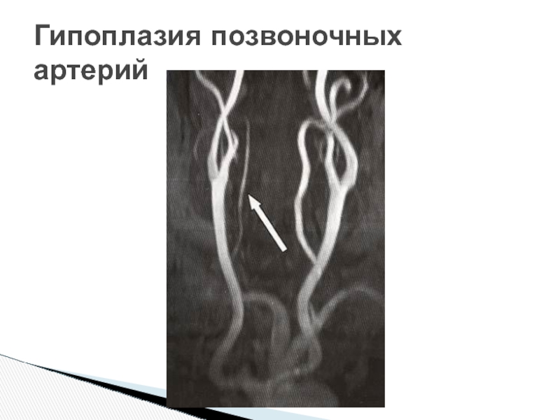 Гипоплазия сегмента v4 позвоночных артерий