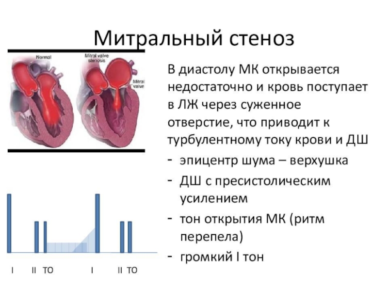 Сердечная недостаточность митрального клапана. 1 Тон сердца при митральном стенозе. Митрального стеноза границы. Тоны сердца при митральном стенозе. Механизм стеноза митрального клапана.