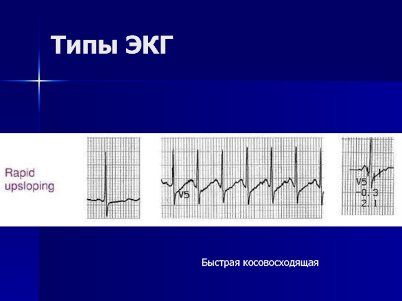 Экг быстро. S1q3 Тип ЭКГ. С Тип ЭКГ. Типы электрокардиографов. Разновидности электрокардиографии.