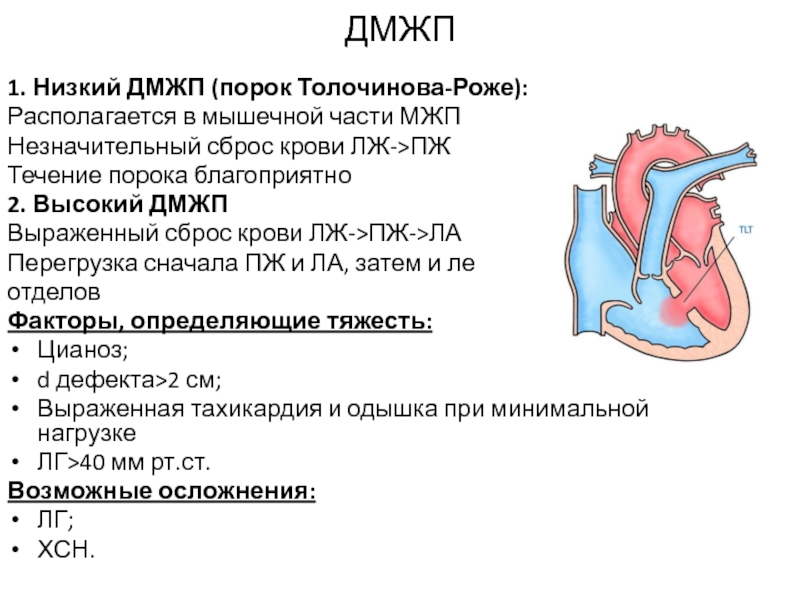 Дефект межжелудочковой перегородки картинки