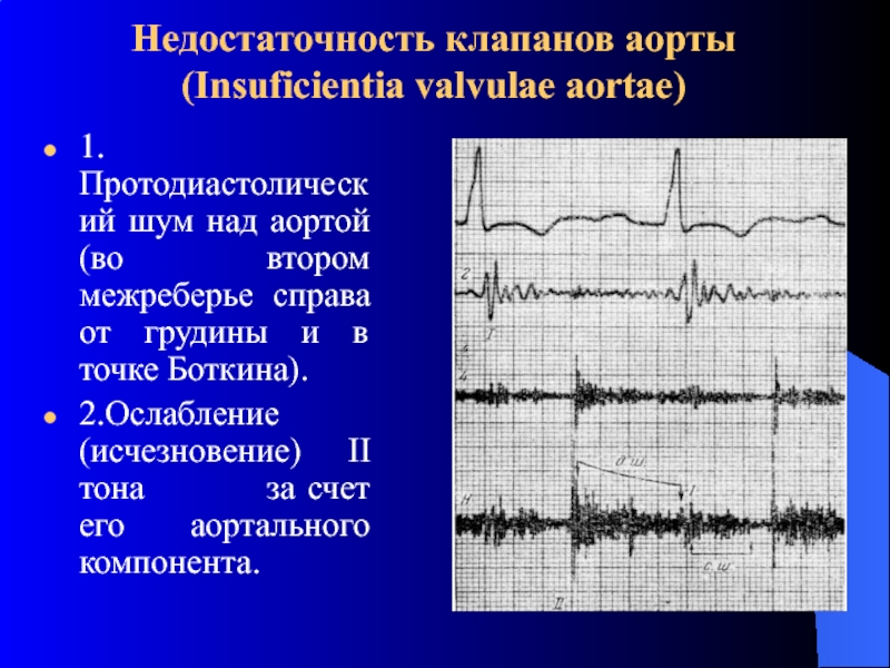 Недостаточность клапанов бпв слева