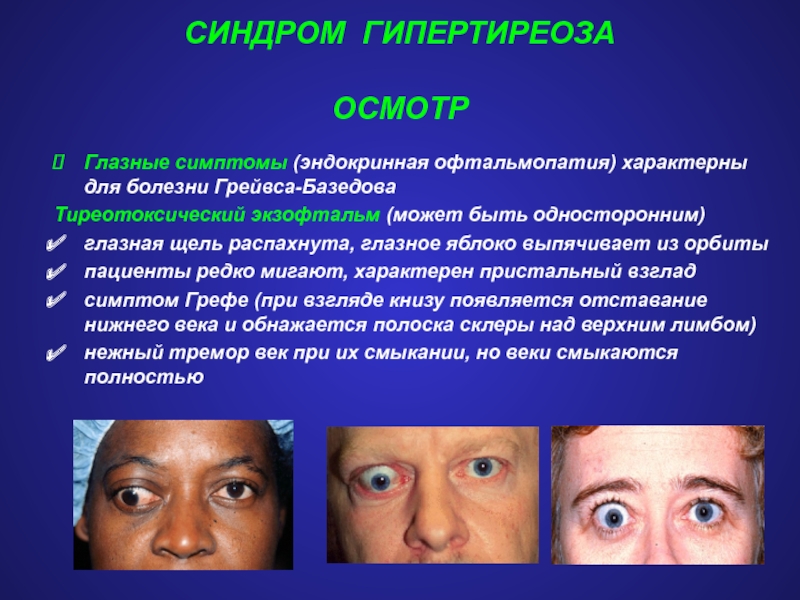 Экзофтальм наблюдается при. Эндокринная офтальмопатия синдромы. Эндокринная офтальмопатия (болезнь Грейвса). Болезнь Грейвса базедова симптомы. Тиреотоксикоз глазные проявления.