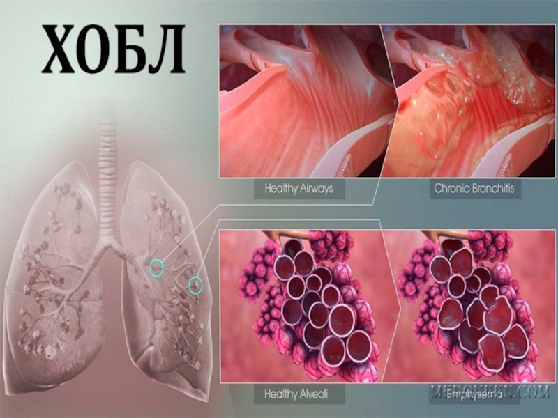 Презентация хроническая обструктивная болезнь лёгких