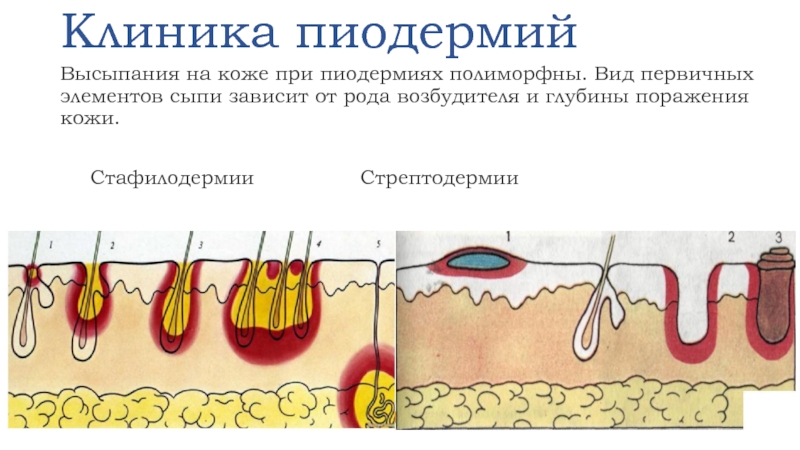 Пиодермия презентация по дерматовенерологии